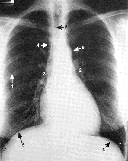 prostý snímek - RTG anatomie 1. plicní pole 2. hilus levý 3. hilus pravý 4. okraj trachea 5.