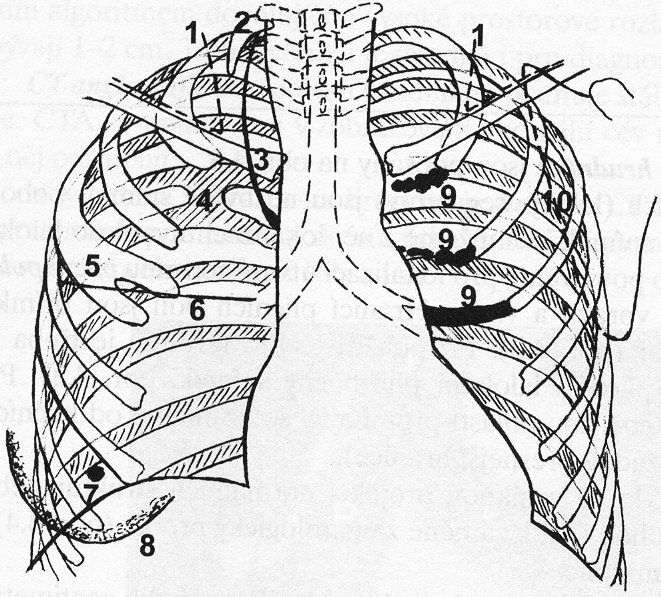 prostý snímek - diagnostické rozpaky 1. stín měkkých tkání 2. krční žebro 3. lobus venae azygos 4. kostní můstek mezi žebry 5.