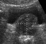 Močový měchýř, prostata Velikost prostaty: 45 (boční) x 35