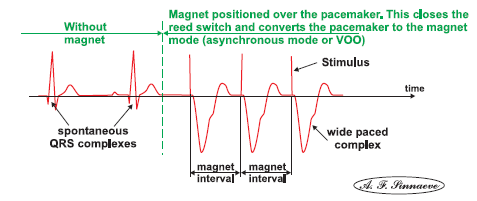 Magnet rate Odpověď PM na magnet: magnet rate VOO nebo DOO, kolem 65-90/min Odpověď ICD na magnet: inhibice antitachykardických funkcí, režim zůstává