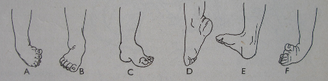Pes calcaneovalgus (pes supinatus) congenitus je vrozenou deformitou, při níž je noha v hákovitém postavení a nelze ji převést přes pravý uhel do plantární flexe.