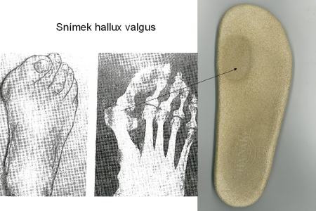 4.8.7 Statické deformity předonoží doprovázejíci plochou nohu Valgózní úchylka palce (Hallux valgus) Hallux valgus je velmi často spojen se statickou plochou nohou dospělých.