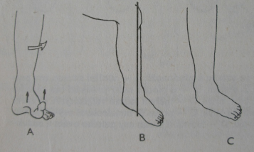 5.0.3 Funkční testy chodidel Véleho test Pro odrazovou prstů, která bývá nejčastěji utlumena, používame Vélova testu, kdy pacient přenáší váhu ke špičce nohy, aniž zvedá paty a kdy má docházet k