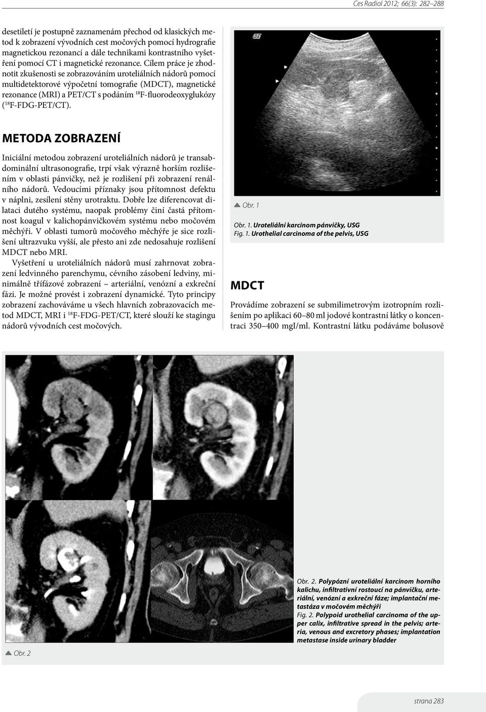 Cílem práce je zhodnotit zkušenosti se zobrazováním uroteliálních nádorů pomocí multidetektorové výpočetní tomografie (MDCT), magnetické rezonance (MRI) a PET/CT s podáním 18 F-fluorodeoxyglukózy (
