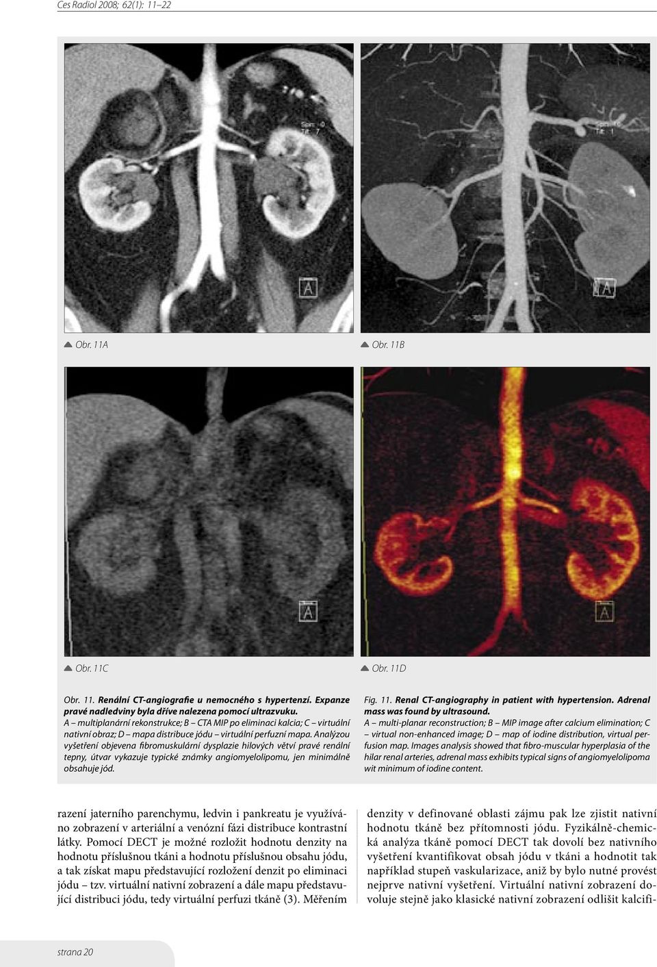 Analýzou vyšetření objevena fibromuskulární dysplazie hilových větví pravé renální tepny, útvar vykazuje typické známky angiomyelolipomu, jen minimálně obsahuje jód. Fig. 11.