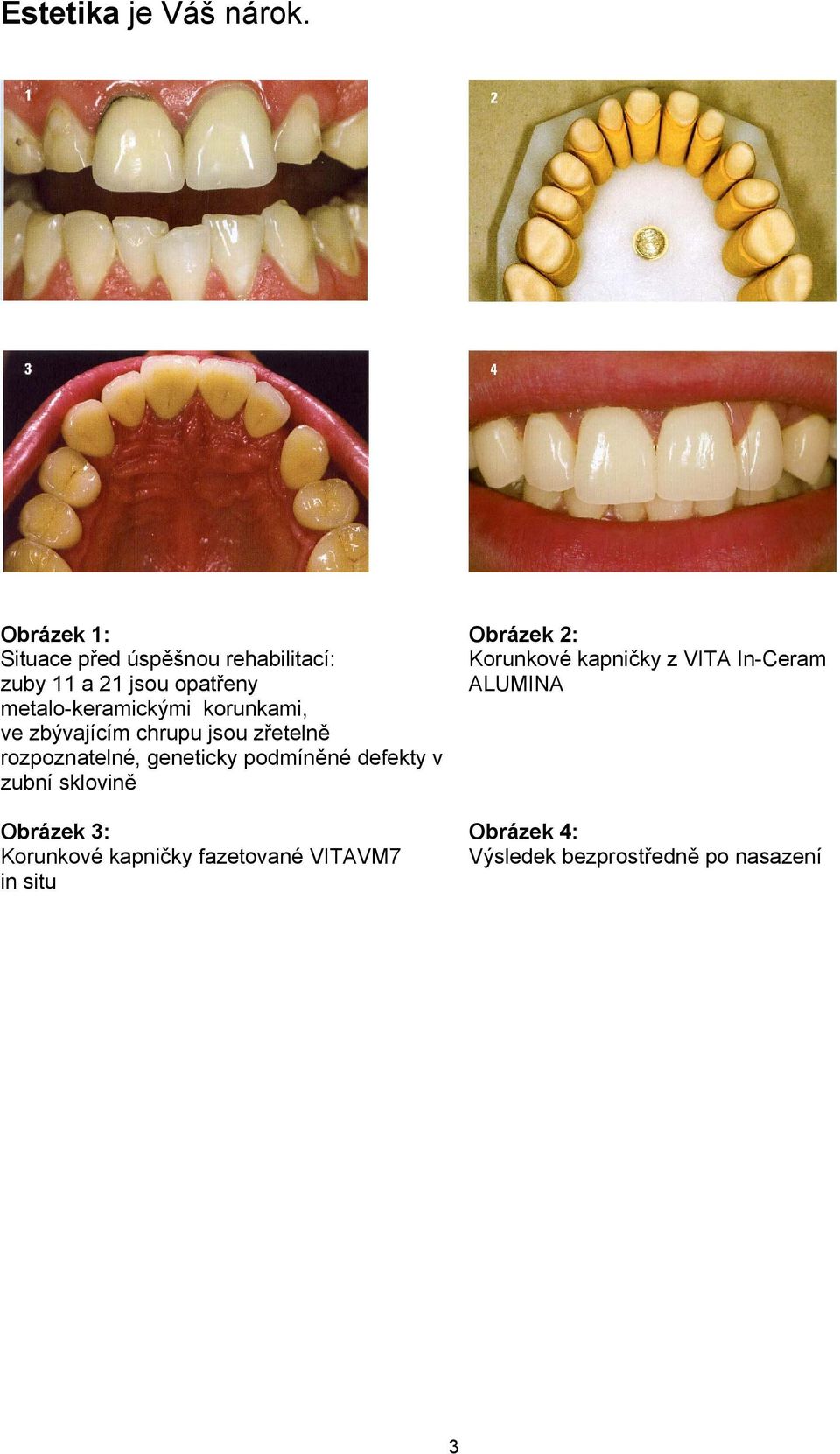 korunkami, ve zbývajícím chrupu jsou zřetelně rozpoznatelné, geneticky podmíněné defekty v