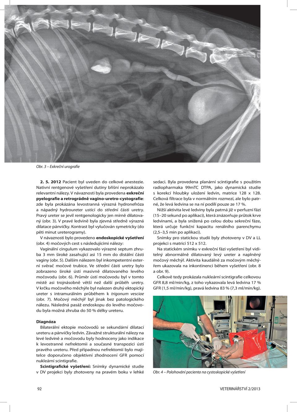 Pravý ureter se jevil rentgenologicky jen mírně dilatovaný (obr. 3). V pravé ledvině byla zjevná středně výrazná dilatace pánvičky. Kontrast byl vylučován symetricky (do pěti minut ureterogramy).