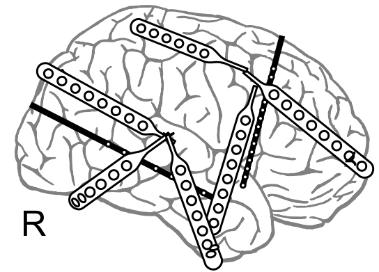 Data a metody 2.1.2 Pacient 2 Druhým vybraným pacientem je pětiletý chlapec trpící tuberózní sklerózou a epilepsií od novorozeneckého věku.