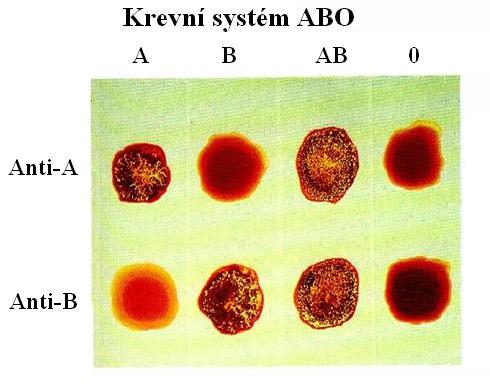 Krevní skupina kodominance alel: I A s I B úplná dominance