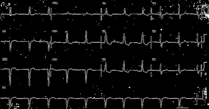 EKG změny Elektrokardiograficky pokládáme za projev ischemie zátěží vyprovokovanou horizontální nebo descendentní depresi úseku ST >1mm (0,1mV) a trvající 80 ms od