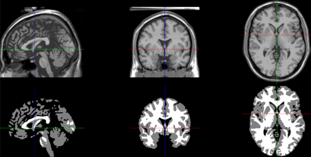 Ing. Radek Janča Analýza intrakraniálních EEG signálů v epileptologii Obr. 5.9: Aplikace segmentačního algoritmu na MRI obraz k odlišení šedé a bílé hmoty.