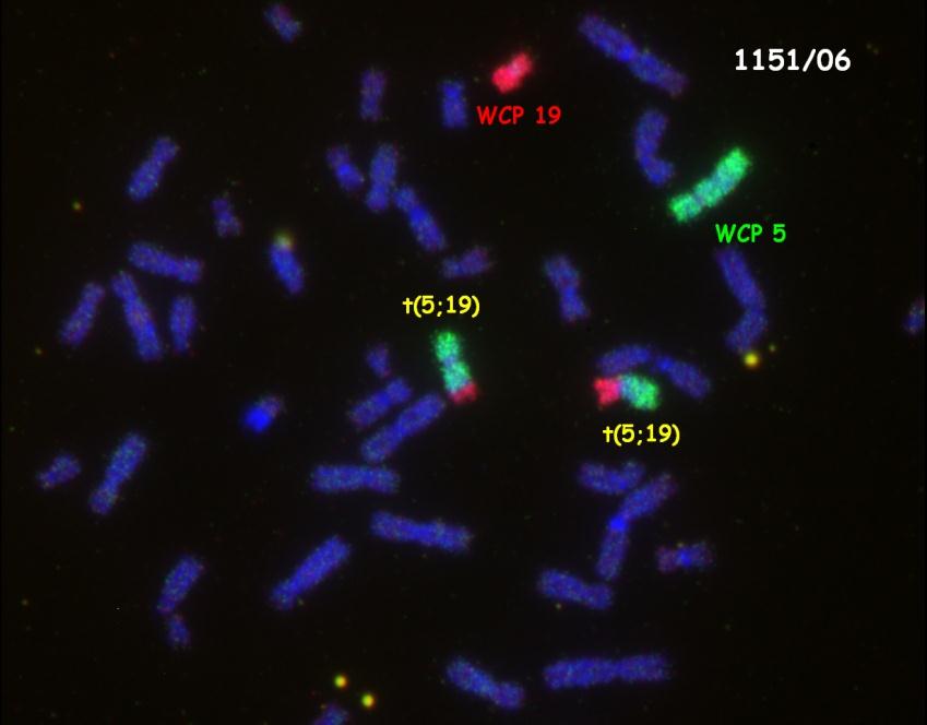 VROZENÉ CHROMOSOMOVÉ ABERACE (VCA) - příklady potvrzení přítomnosti balancované