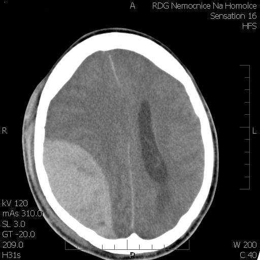 Epidural