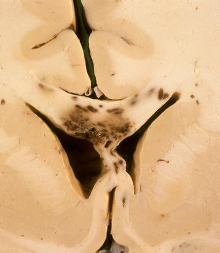 Direct acute brain injuries Diffuse axonal injury (DAI)