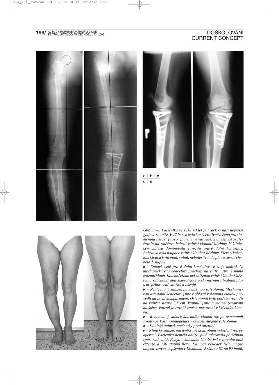V klinickém nálezu dominovala varozita pravé dolní končetiny. Bolestivá byla palpace vnitřní kloubní štěrbiny. Flexe v kolenním kloubu byla plná, volná, nebolestivá, do plné extenze chybělo 5 stupňů.