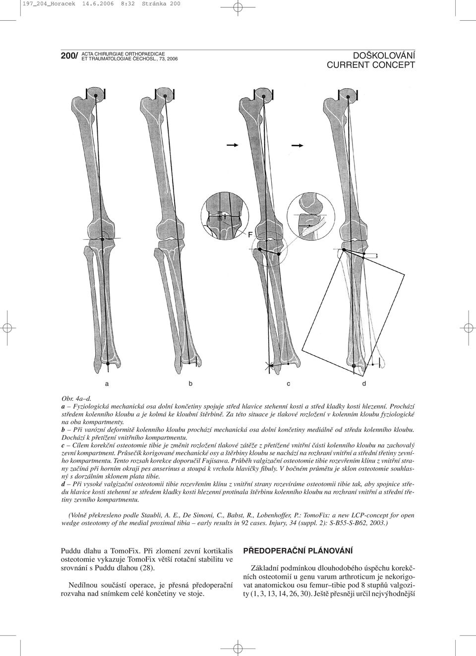 b Při varózní deformitě kolenního kloubu prochází mechanická osa dolní končetiny mediálně od středu kolenního kloubu. Dochází k přetížení vnitřního kompartmentu.