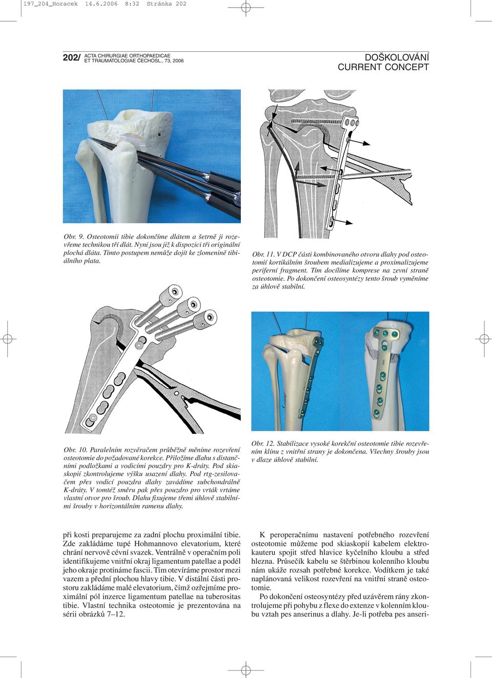 Tím docílíme komprese na zevní straně osteotomie. Po dokončení osteosyntézy tento šroub vyměníme za úhlově stabilní. Obr. 10.