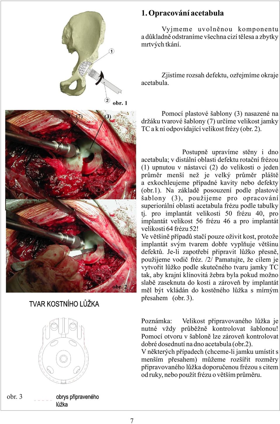 Postupnì upravíme stìny i dno acetabula; v distální oblasti defektu rotaèní frézou (1) upnutou v nástavci (2) do velikosti o jeden prùmìr menší než je velký prùmìr pláštì a exkochleujeme pøípadné