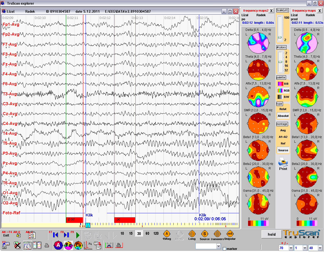Obr. 3. 1. Naměřené hodnoty s viditelnou beta aktivitou na pravé mozkové hemisféře Na záznamu jsou dva sloupce frekvenčního BM. Levý sloupec vyjadřuje aktivitu po pohybu.