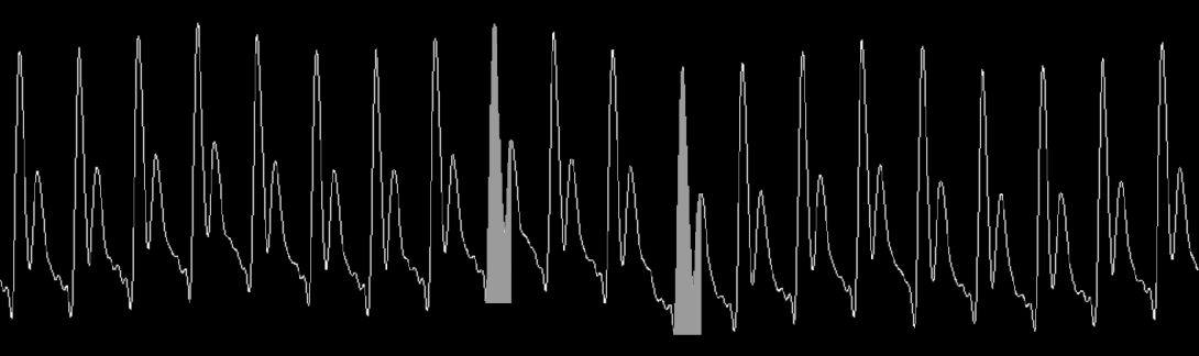 5.1 Dynamické parametry Variabilita tepového objemu Stroke volume variation SV V = SV max SV min 100 [%] (SV max + SV min )/2 norma do 10 % Variabilita tlakové amplitudy Pulse pressure variation