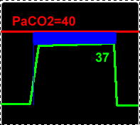 Trocha fyziologie Rozdíl mezi PaCO2 alveolů a ETCO2 = 2-5 mmhg Alveolární tlak
