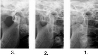 OVLÁDACÍ PANEL Dvojitý laterál-pa: Laterální a posterioanteriorní snímek otevřených a zavřených TMJ kloubů.
