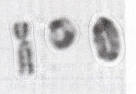 ZÍSKANÉ CHROMOSOMOVÉ ABERACE (ZCA)- typ poškození chromosomové aberace označení chr acentrické