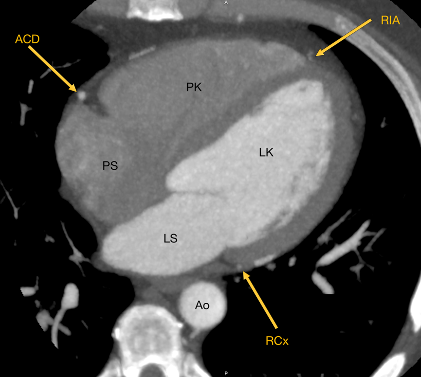 Obrázek 3 CT srdce s cévami, 3D rekonstrukce / RIA ramus interventricularis anterior, RCx ramus circumflexus/ (Autor: MUDr.