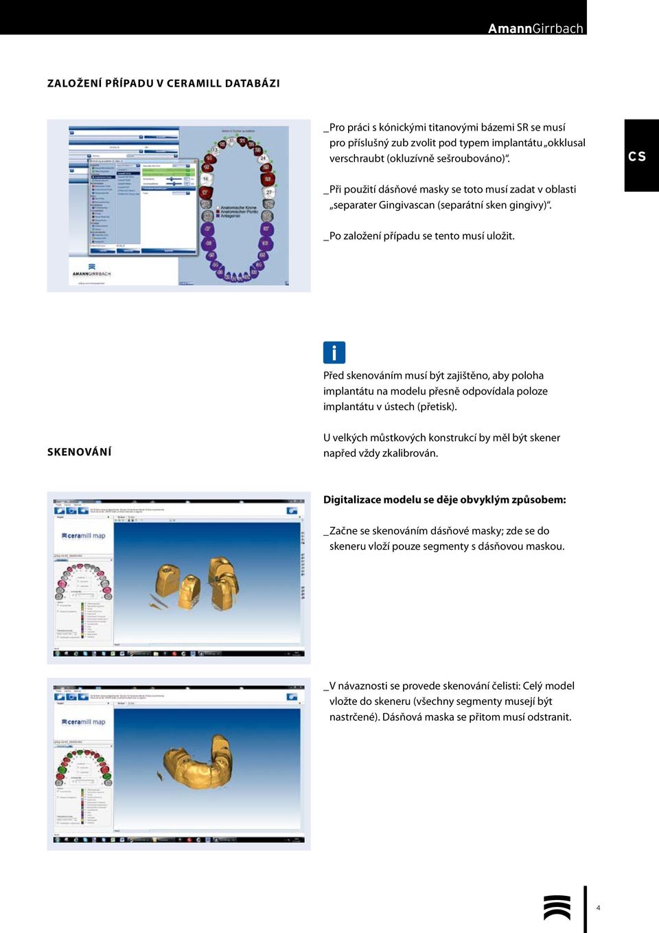 Před skenováním musí být zajištěno, aby poloha implantátu na modelu přesně odpovídala poloze implantátu v ústech (přetisk).
