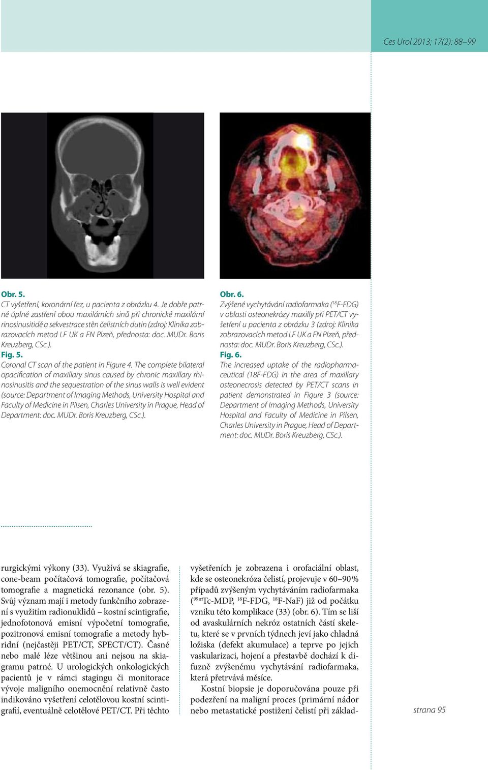 MUDr. Boris Kreuzberg, CSc.). Fig. 5. Coronal CT scan of the patient in Figure 4.