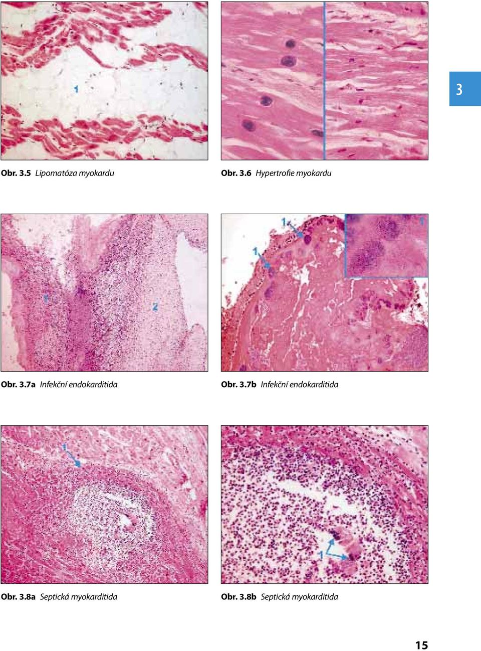 7b Infekční endokarditida Obr. 3.
