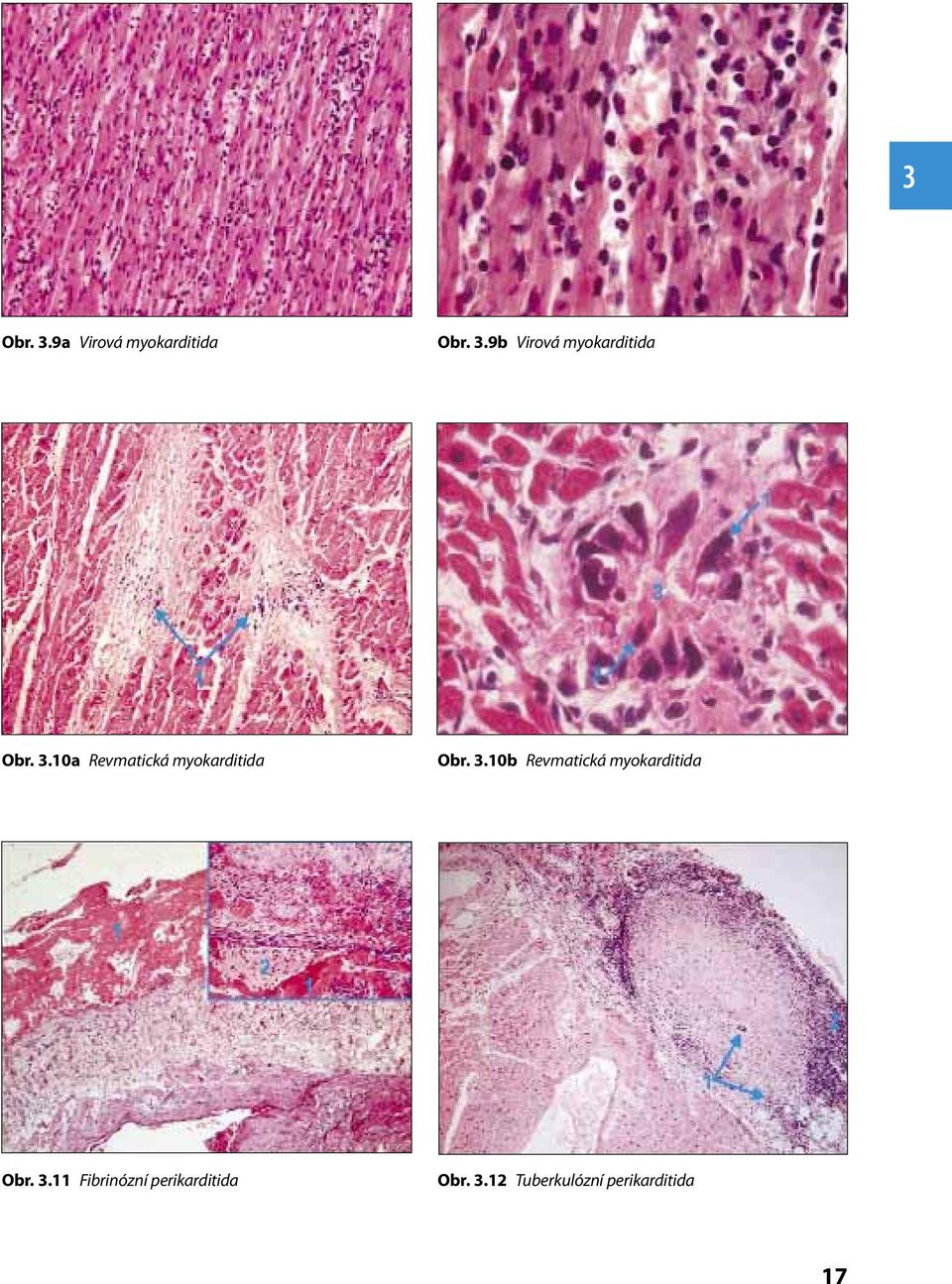 10b Revmatická myokarditida Obr. 3.