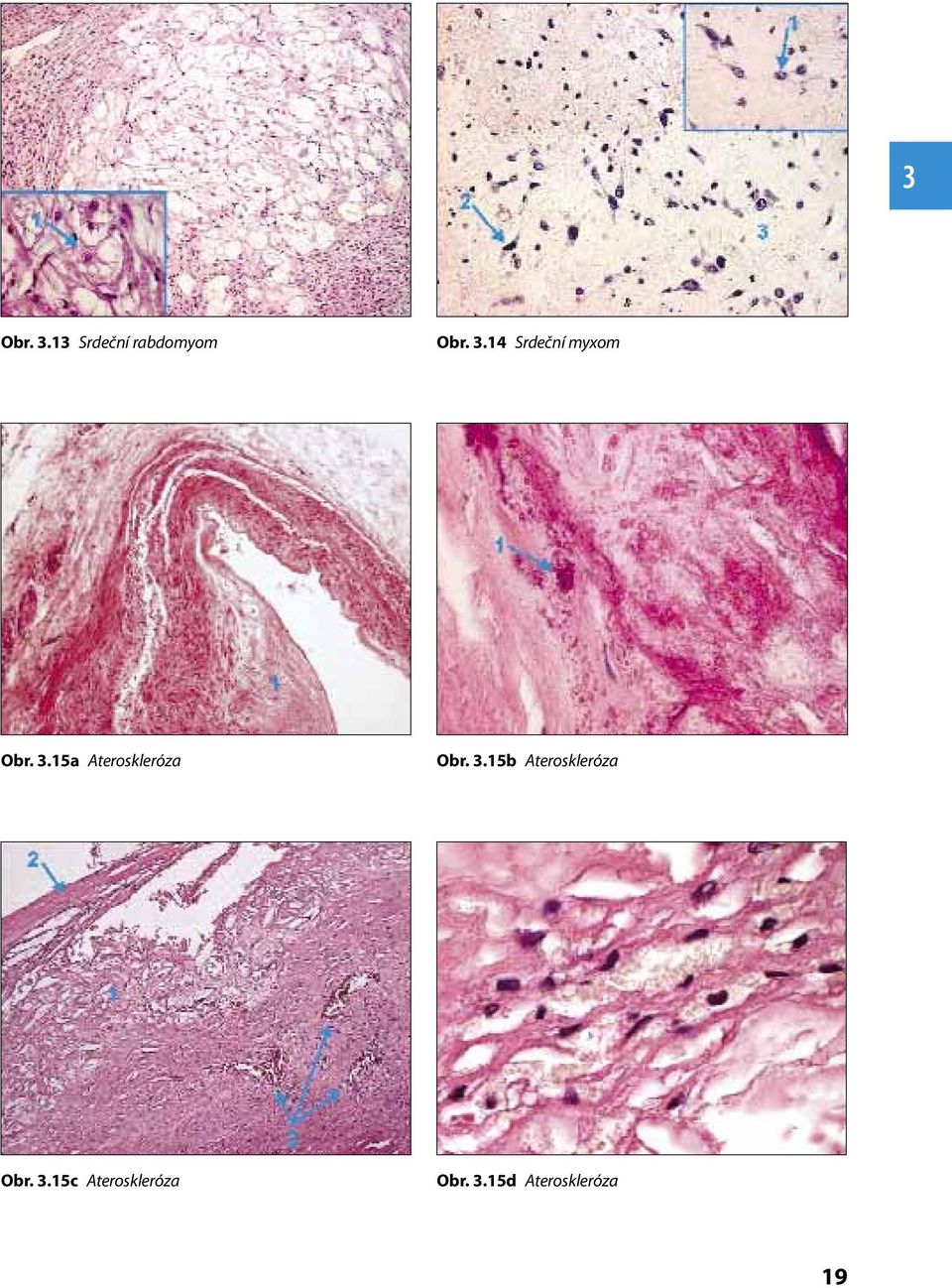 15b Ateroskleróza Obr. 3.