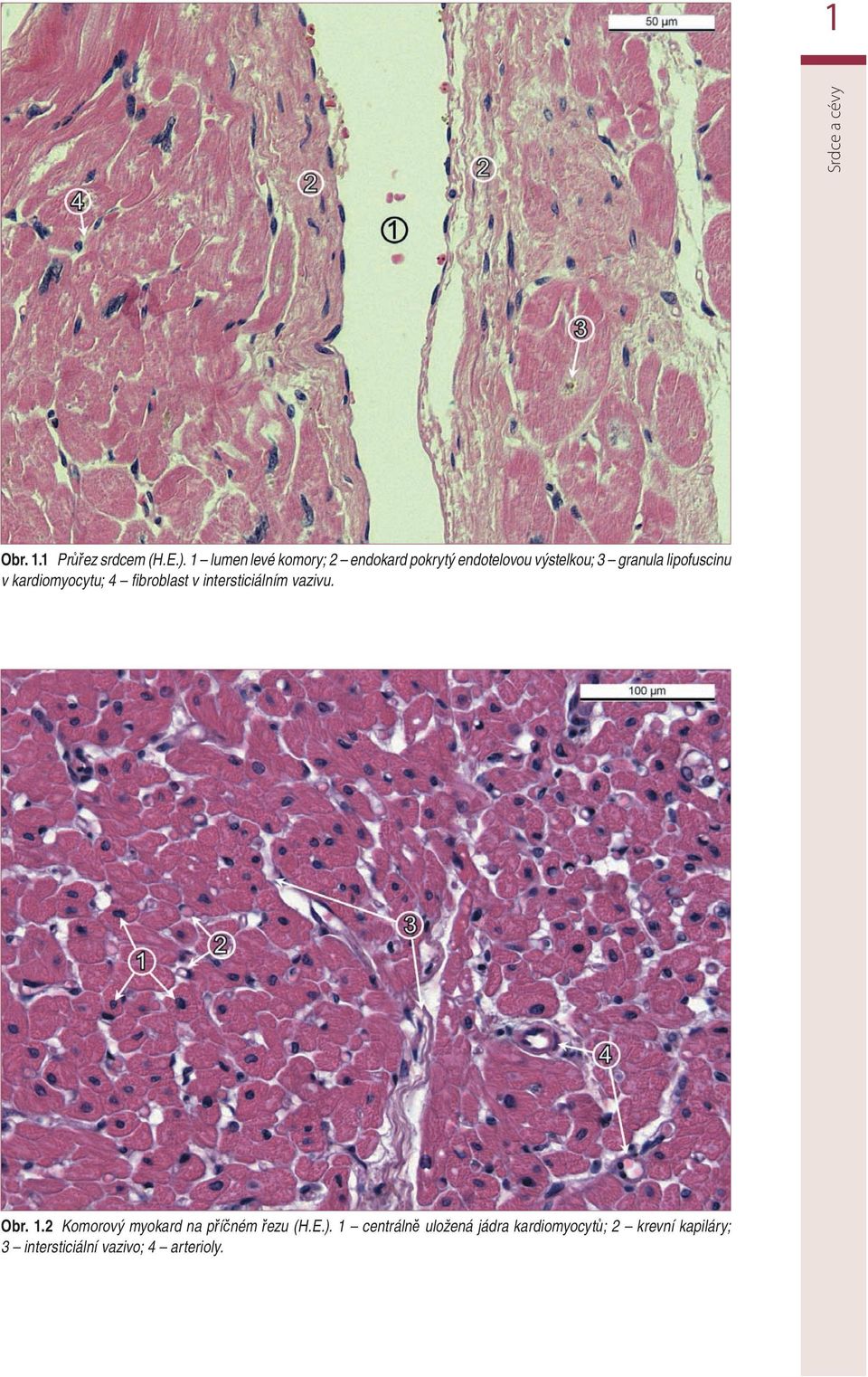 lipofuscinu v kardiomyocytu; 4 fi broblast v intersticiálním vazivu. Obr. 1.