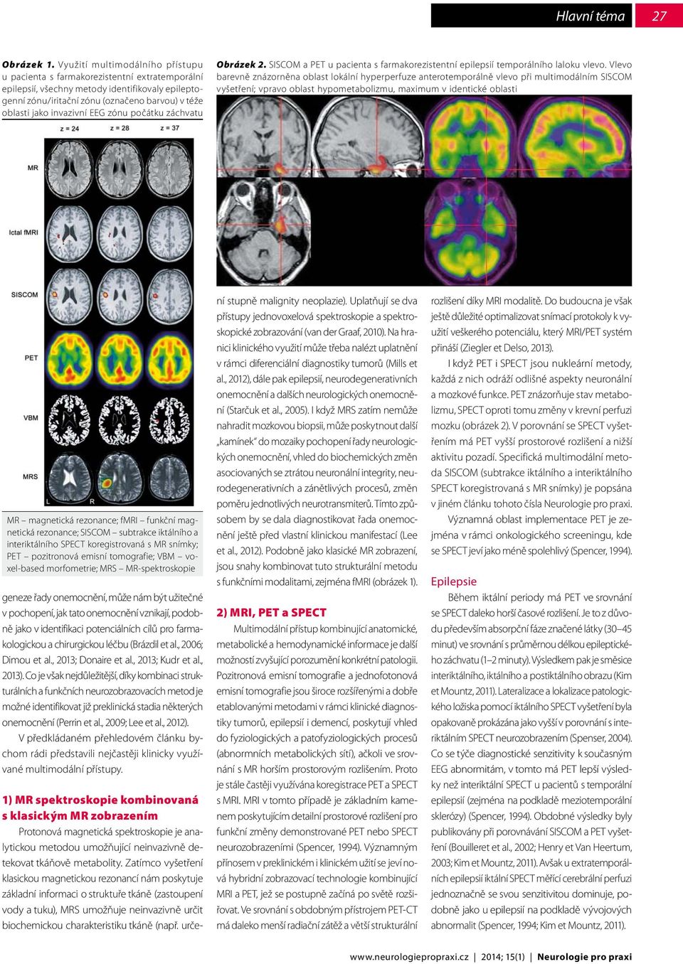 invazivní EEG zónu počátku záchvatu Obrázek 2. SISCOM a PET u pacienta s farmakorezistentní epilepsií temporálního laloku vlevo.