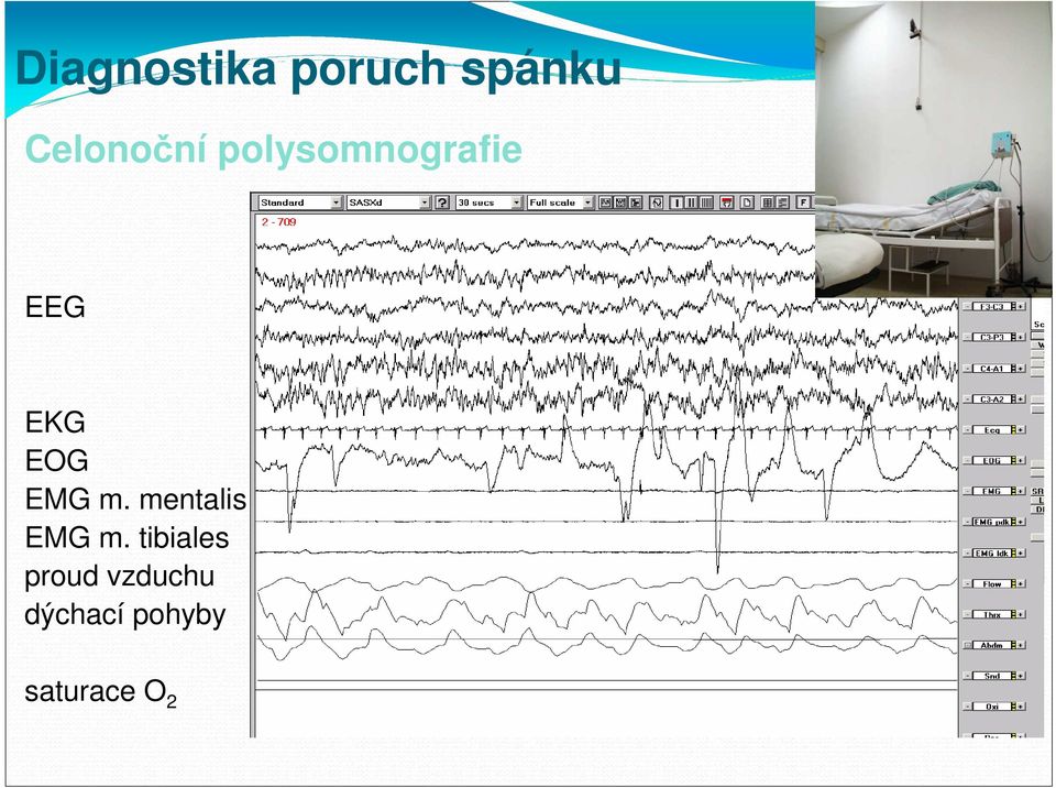 EOG EMG m. mentalis EMG m.