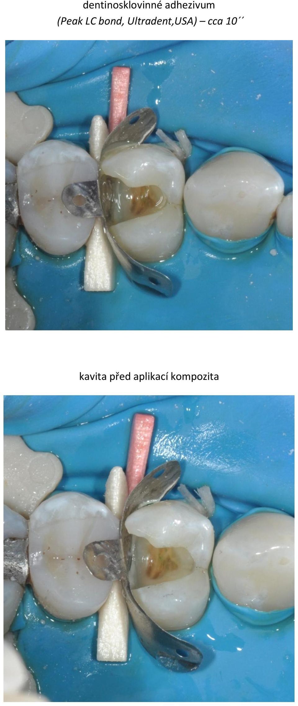 bond, Ultradent,USA)