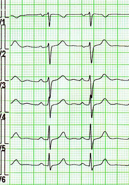 EKG sinusový rytmus I II III