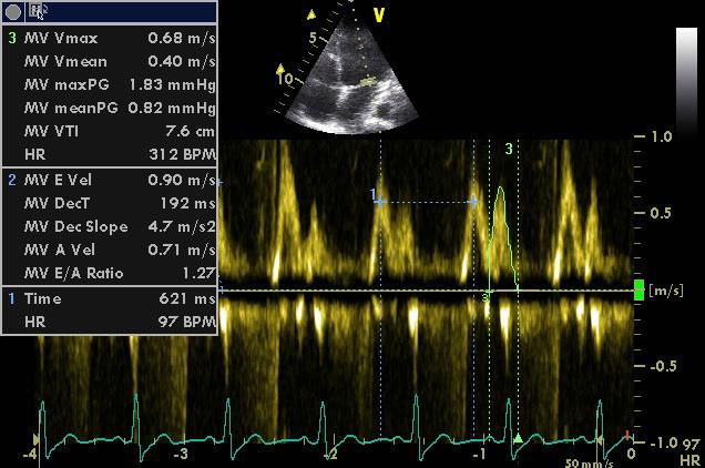Esmolol bezpečně a bez DO 2 /VO 2 kompromisu sníží HR na 110-120/min Stroke volume index: Změny diastolické funkce: A vlna Pokles ze 140 na
