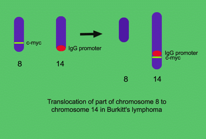 Burkittův lymfom translokace [der(8;14), der(2;8), der(8;22)]