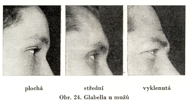 *Glabella: 1. plochá, 2. střední, 3.