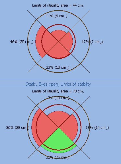 Velké zlepšení nastalo v celkové ploše limitů stability. Při konečném vyšetření byla naměřená hodnota téměř dvakrát vyšší, než na začátku.