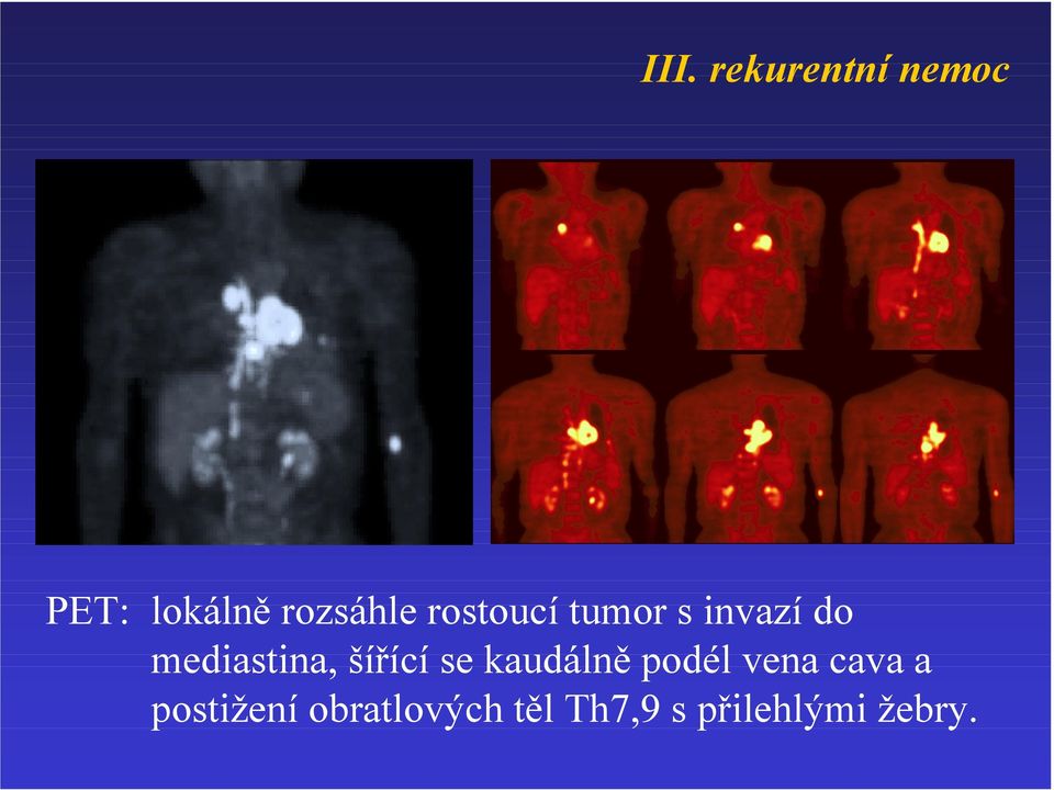 mediastina, šířící se kaudálně podél vena