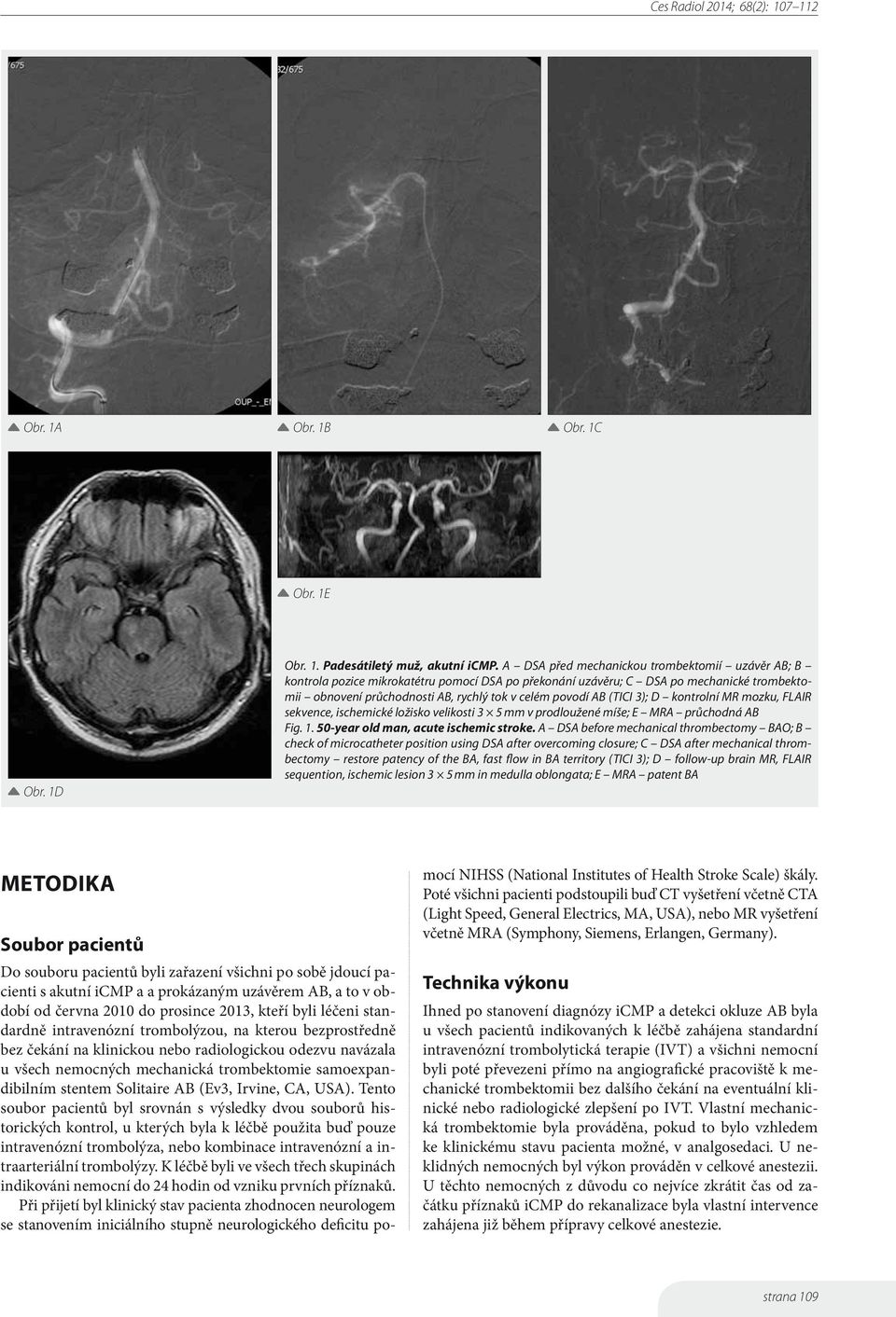 (TICI 3); D kontrolní MR mozku, FLAIR sekvence, ischemické ložisko velikosti 3 5 mm v prodloužené míše; E MRA průchodná AB Fig. 1. 50-year old man, acute ischemic stroke.