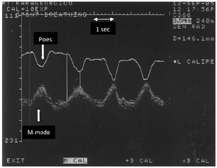 Monitoring synchronizace pac dechového úsilí a podpory IPPV - M mode bránice a Paw - TF odpovídá aktivní kontrakci dech svalů - Synchronizace s Poes - TF jako