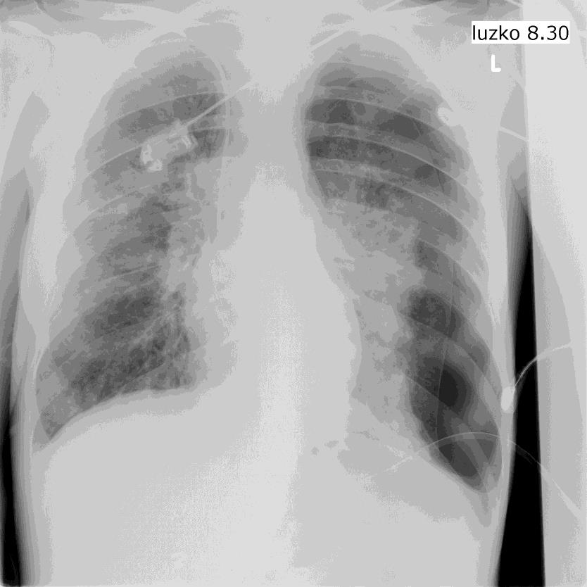 Faktory modifikující neuromuskulární funkci bránice na ICU Pleurální patologie Výpotek