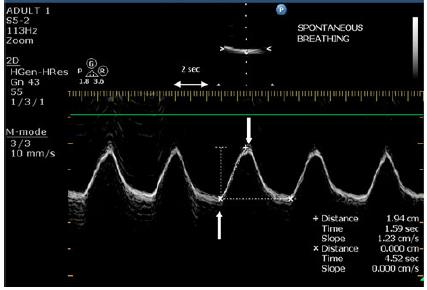 Ultrazvuk: DIA (diafragmatická amplituda) - Phassed array sonda 2D + Mmode (2-4 MHz) - Mezi medioklavikulární a přední axilární linií - TTE sonda směrem k zadní třetině (vertexu) bránice u ležícího -