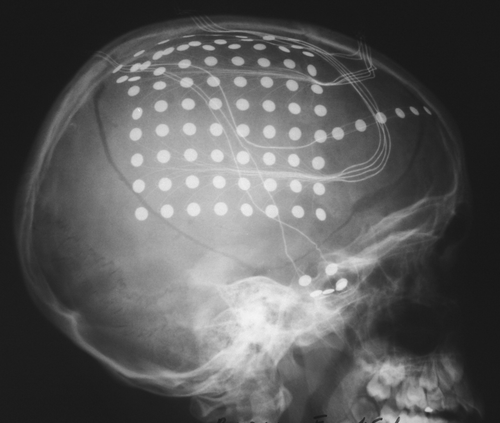 2. Teoretický úvod Obrázek 1. Rentgen s implantací elektrod 2.2. Elektroencefalografie Počátky elektroencefalografie můžeme nají na konci devatenáctého století, kdy byla na zvířatech poprvé zaznamenána elektrická mozková aktivita.