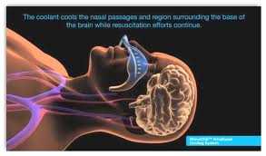 Transnasální ochlahování Intranasal cooling with the RhinoChill device appears safe and effectively lowers brain and core temperatures.