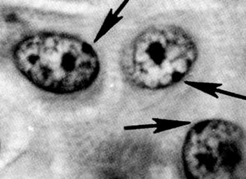 Stanovte počet Barrových tělísek (X chromatin, sex chromatin) ve stěru z bukální sliznice u jedinců s těmito karyotypovými nálezy: a)